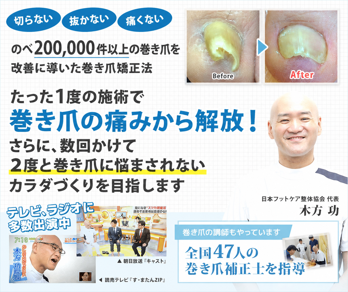 手術をするのはちょっと待った!!痛くて伸ばせないその巻爪 たった一度の施術で痛みから解放
