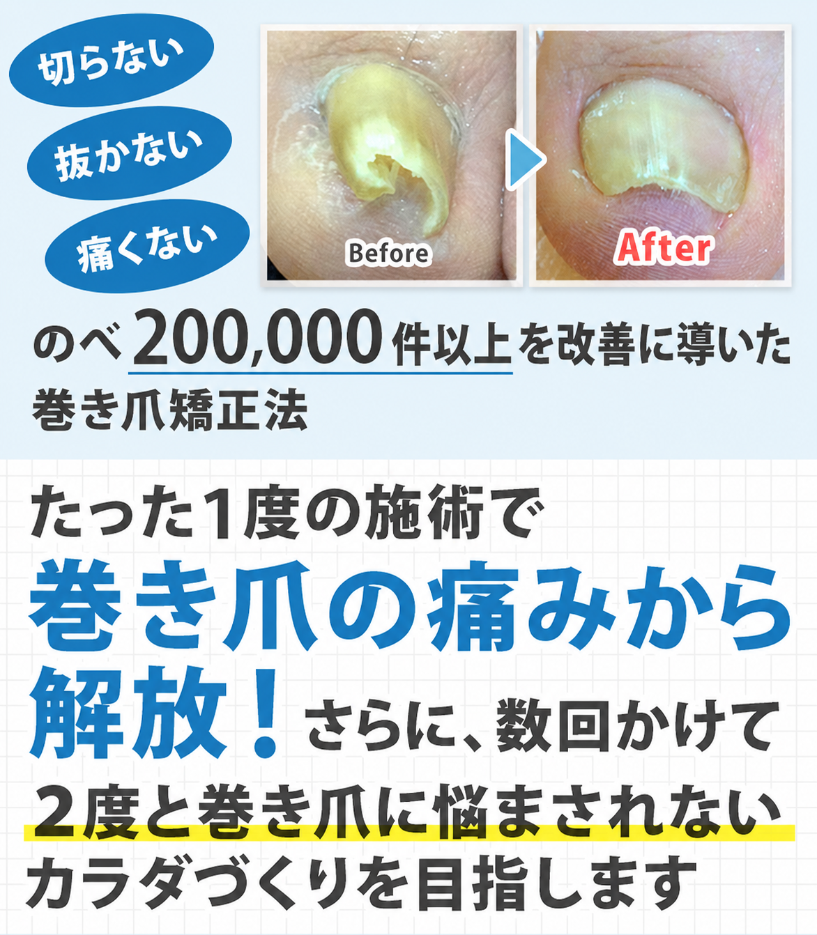 手術をするのはちょっと待った!!痛くて伸ばせないその巻爪 たった一度の施術で痛みから解放