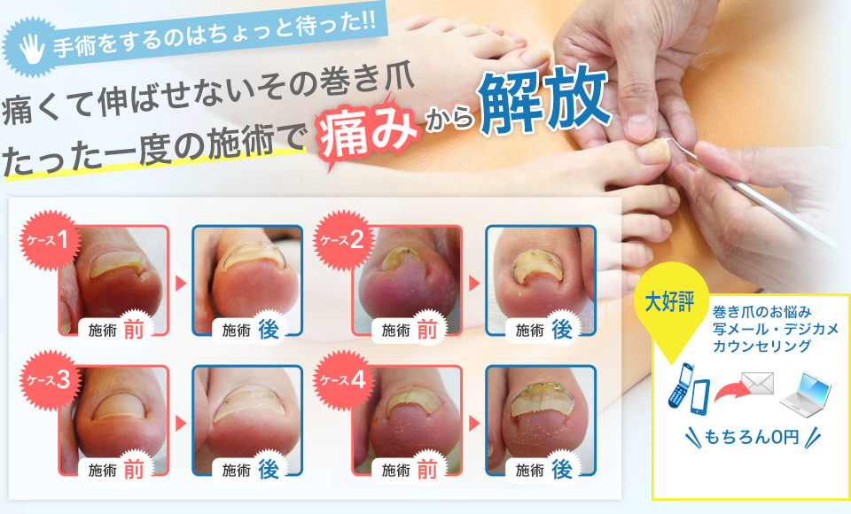 巻き爪の治療は病院 何科 整体院 大阪 茨木市の巻爪補正専門整体