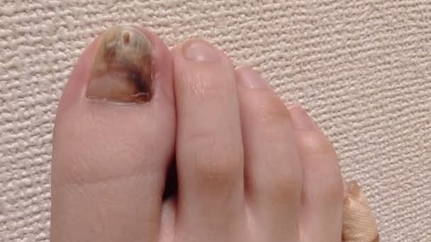 親指の爪が痛い ランニングで爪が黒くなった原因を解説します 大阪 茨木市の巻爪補正専門整体 大阪巻き爪フットケア専門院