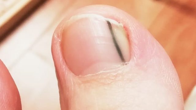妊娠中に 足の爪に黒い線 ができるのは色素沈着が原因かもしれません 大阪 茨木市の巻爪補正専門整体 大阪巻き爪フットケア専門院